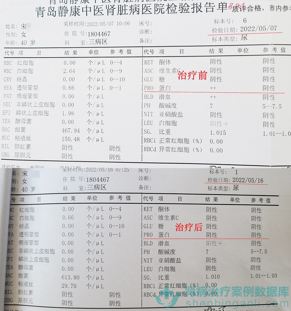 患了狼疮肾病很恐慌？山东青岛静康医院治疗得当可转阴！